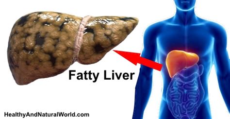 Fatty Liver Hepatic Steatosis Signs Symptoms And Prevention