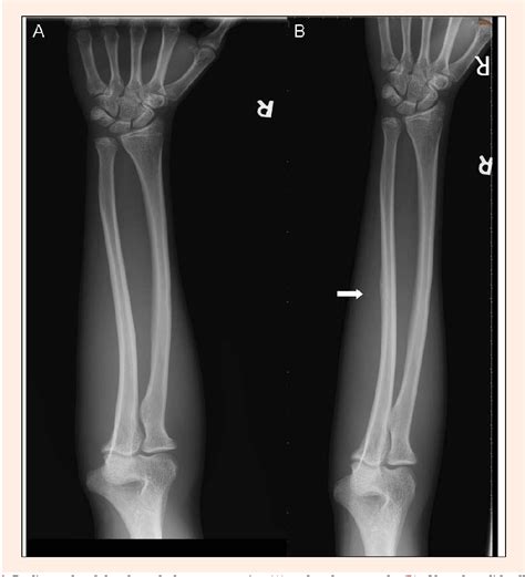 Figure 2 From Stress Fracture Of The Ulna In A Break Dancer Semantic