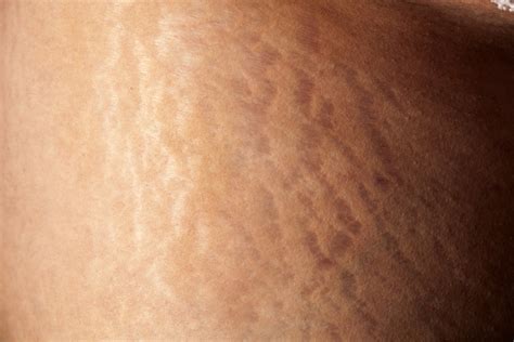 The Different Colors And Types Of Stretch Marks