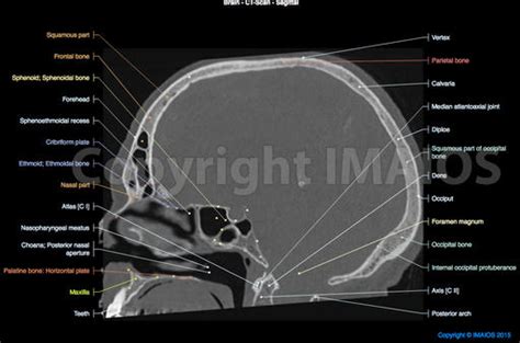 Atlas Bone Anatomy Cranial Nerve
