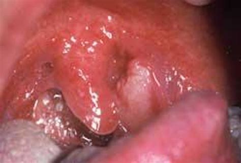 Squamous Cell Carcinoma Of The Tonsil Registered Dental Hygienist