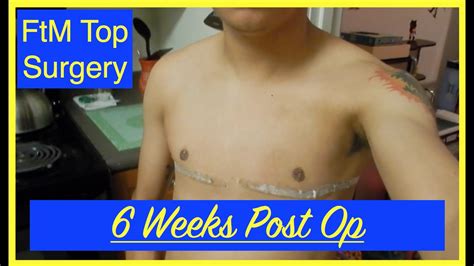 Top Surgery Update 6 Weeks Post Op Ftm Transgender Youtube