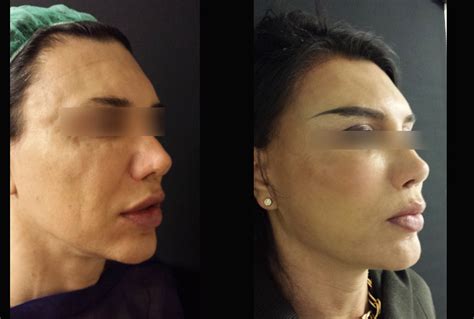 Facial Feminization 241 Aesthetic Day Surgery Dr Agostino