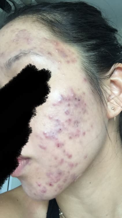 Dark Purple Marks All Over Facecystic Acne Hyperpigmentation Red