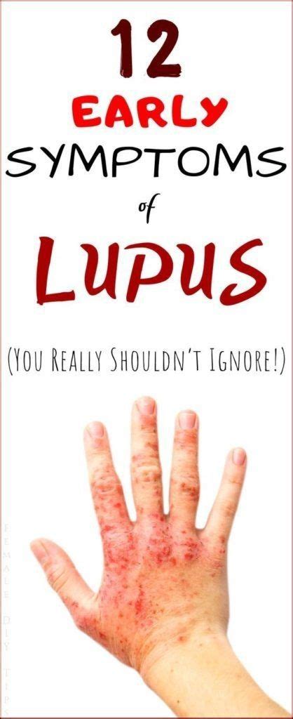 12 Early Warning Signs Of Lupus You Need To Know And What To Do The