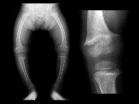 Aneurysmal Bone Cyst Findings Expansile Lytic Lesion Of