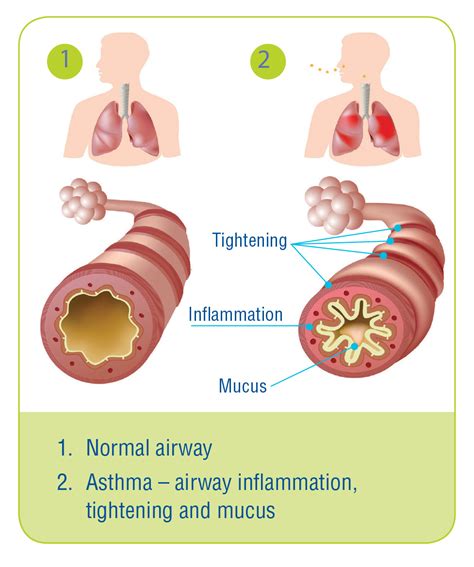 Asthma The Lung Association