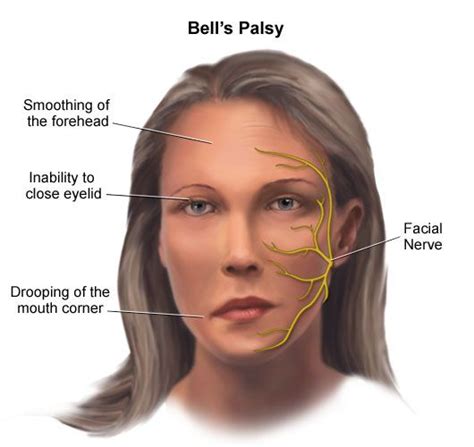 Earnosethroat Headandneckmedicine Facial Exercises For Bells Palsy