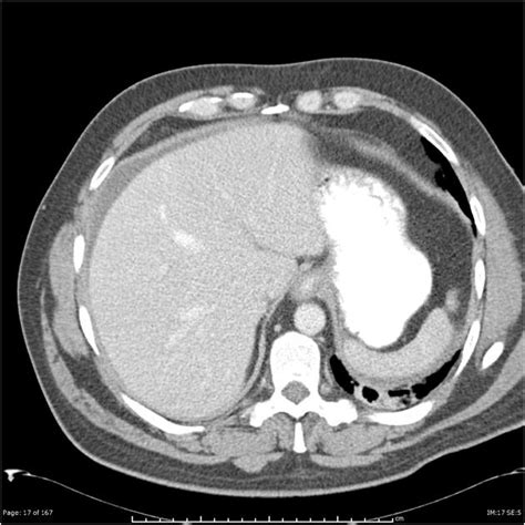 Simplifying therapy for type iii hereditary angioedema. Hereditary angioedema | Radiology Case | Radiopaedia.org