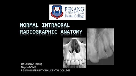 Normal Intraoral Radiographic Anatomy Youtube
