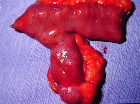 Small Bowel Diverticula Meckels Pictures Surgery Photos