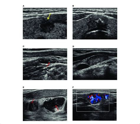 The Ultrasound Features For Delphian Lymph Node Metastasis