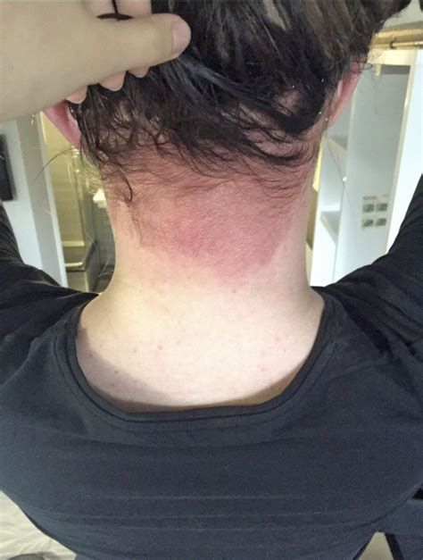 Woman Left Temporarily Blind After Allergic Reaction To Hair Dye