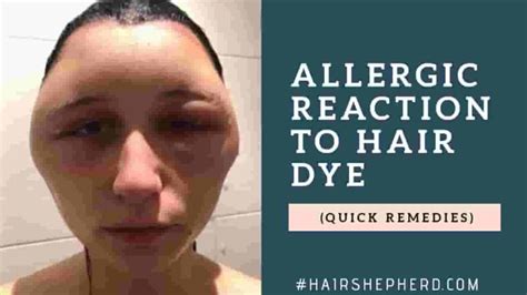 Allergic Reaction To Hair Dye Face Swelling Treatment Archives
