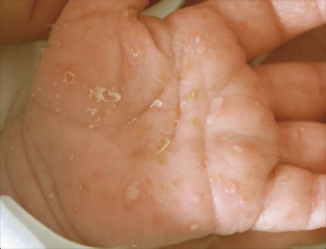 Picture Of The Month—quiz Case Dermatology Jama Pediatrics Jama