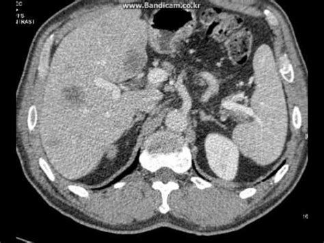 We did not find results for: CT interpretation : pancreas cancer with liver metastasis ...