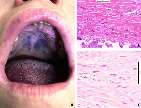 Hard Palate Hyperpigmentation—a Rare Side Effect Of Antimalarials