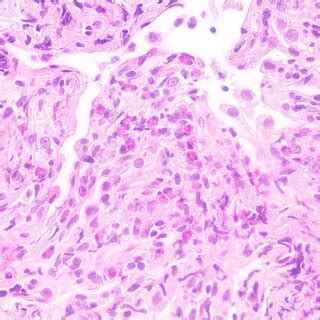 Histopathological Findings Following Transbronchial Lung Biopsy Lung