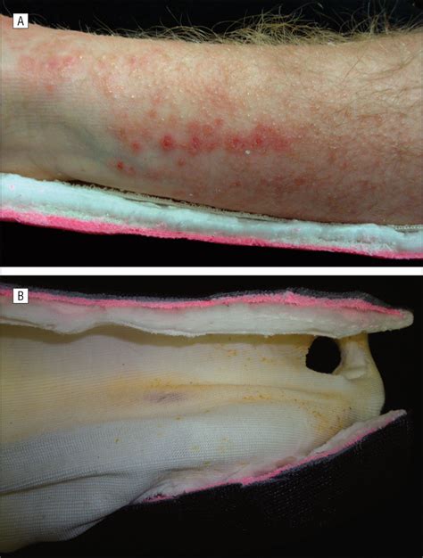 Dermatitis To Fd Andc Yellow No 6 Dye In Orange Antiseptic Solution
