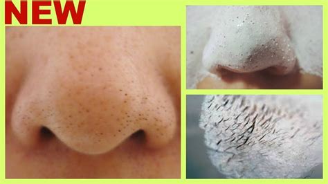 How To Clean Blackheads And Whiteheads On Nose Howotremvo