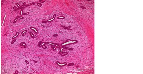 Fibroadenoma Of The Ectopic Axillary Breast Tissue Sonographic Appearances