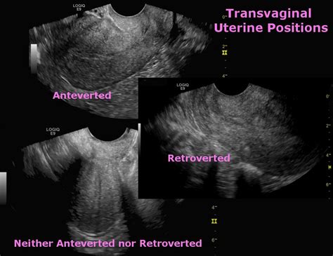 Janet Hoyler On Twitter Uterine Positions On Transvaginal Ultrasound
