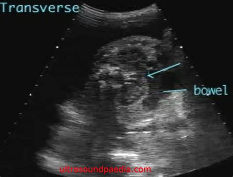 Horseshoe Kidney Ultrasoundpaedia