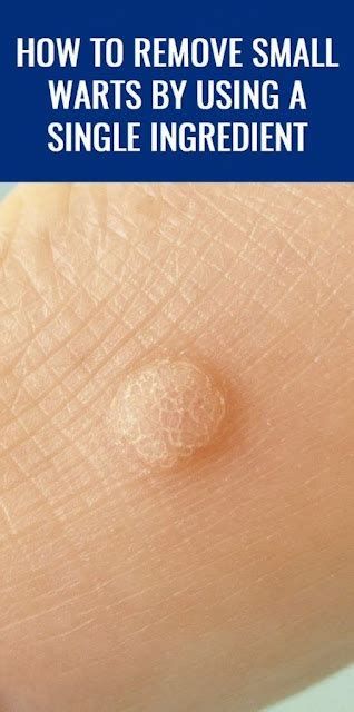 How To Remove Small Warts By Using A Single Ingredient Wellness Days