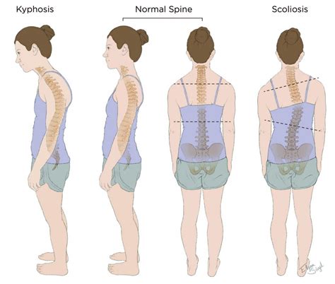 Understanding Scoliosis Kyphosis And Spinal Curvatures Key Insights