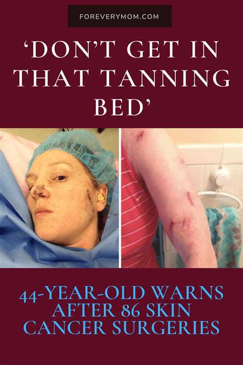 ‘dont Get In That Tanning Bed—44 Year Old Warns After 86 Skin Cancer