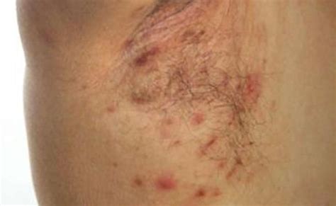 Armpit Rash Itchy Candida Causes Treatment Cuitandokter