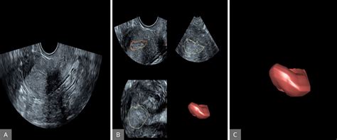 The Role Of Three Dimensional Ultrasound In Gynecology Scitemed