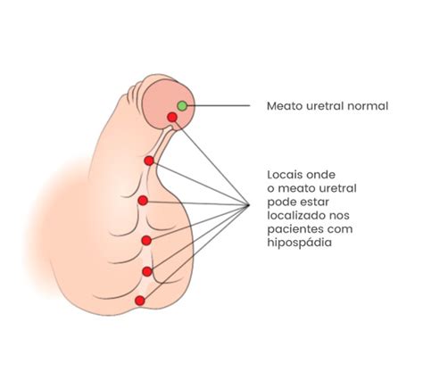 Urologia Pedi Trica E Hiposp Dia Acls Onofre