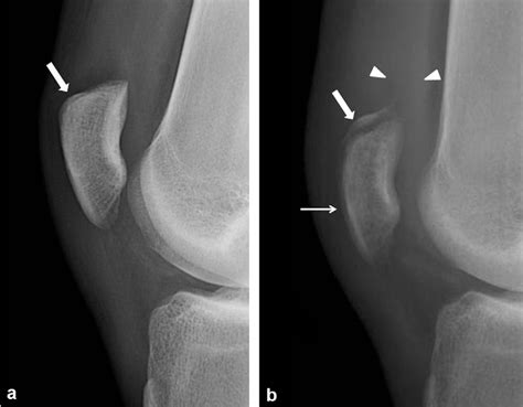 Figure 1 From Sleeve Like Avulsion Fracture Of The Superior Pole Of The
