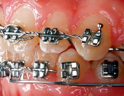 What To Do With A Loose Bracket Orthodontics In London