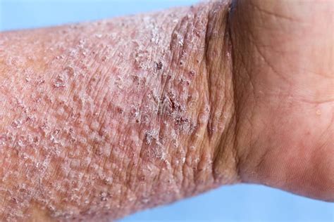 Atopic Dermatitis Ad Also Known As Atopic Eczema Is A Type Of