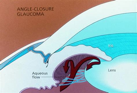 Schematic Of Angle Closure Glaucoma American Academy Of Ophthalmology