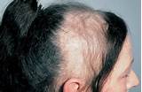 Images of Alopecia Mayo Clinic