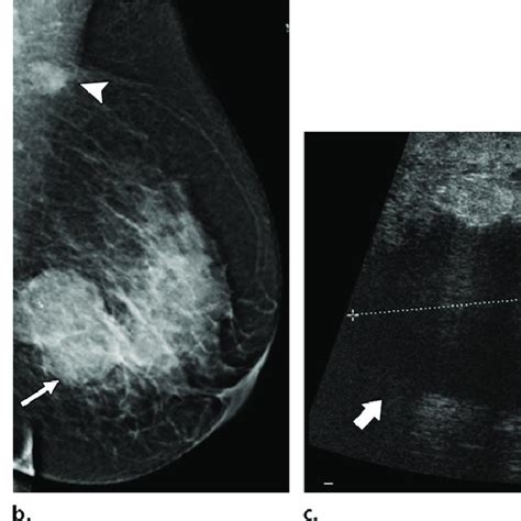invasive ductal carcinoma of the right breast which was detected only download scientific