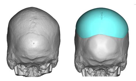 Plastic Surgery Case Study Skull Asymmetry Correction With Occipital