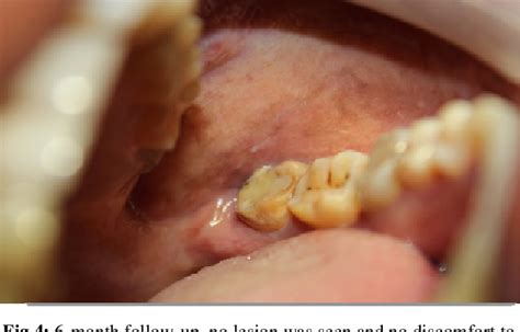 Figure 4 From Oral Lichenoid Contact Lesion To Amalgam Restoration And