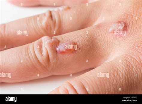 Cryosurgery Hi Res Stock Photography And Images Alamy