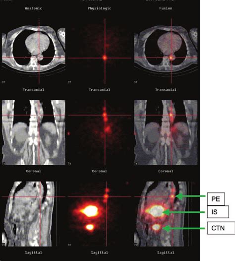 Radioactivity In Paraesophageal Lymph Nodes Pe As Identified