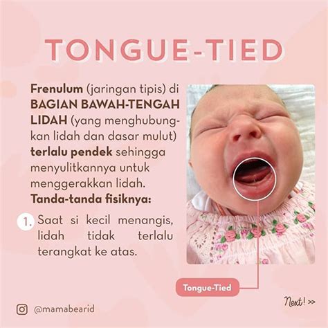 Moms What Is Lip Tied And Tongue Tied In Babies