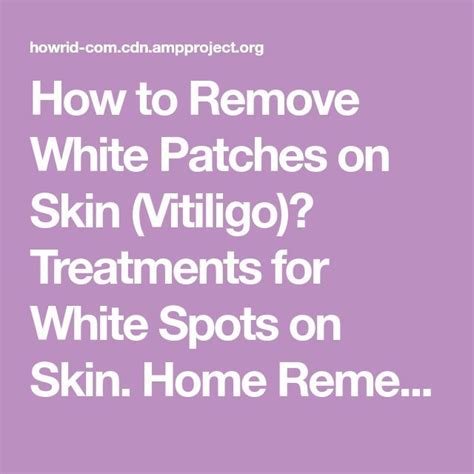 How To Remove White Patches On Skin Vitiligo Treatments For White