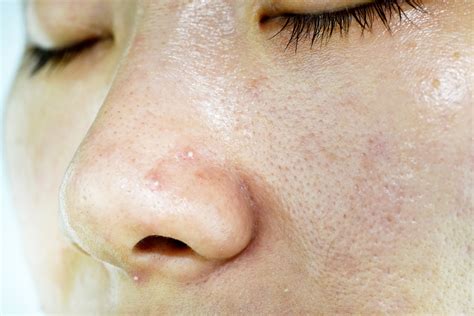 Whiteheads On Nose Causes And How To Get Rid Of Them Asap