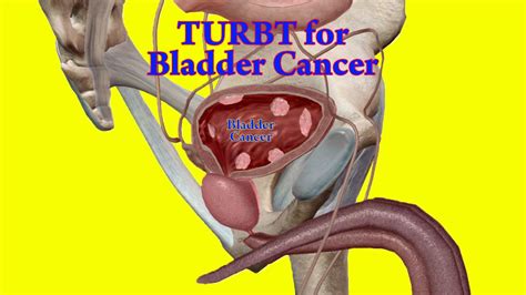 Transurethral Resection Of The Bladder