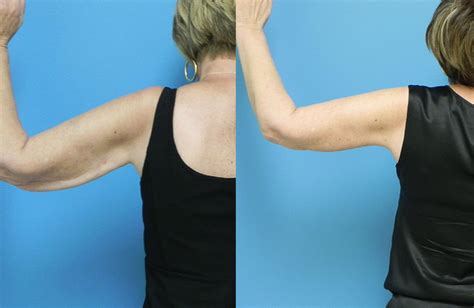 Arm Lift Before And After Pictures Mae Plastic Surgery Chicago Il