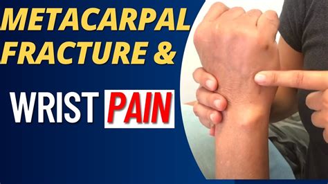 Metacarpal Fracture Rehab Boxers Fracture How Does It Affects Wrist