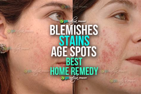 Best Ever Home Remedy To Remove Blemishes Dark Spots And Age Spots